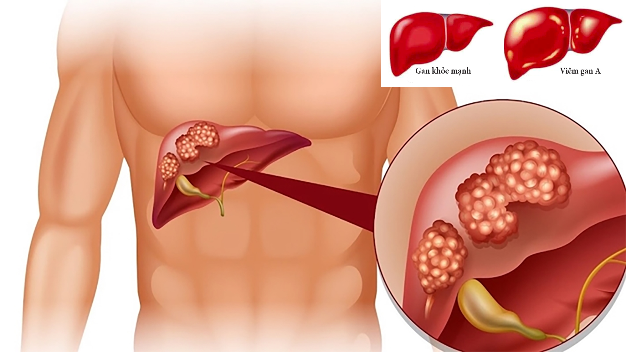 Viêm gan A có điều trị dứt điểm được không?- Ảnh 1.