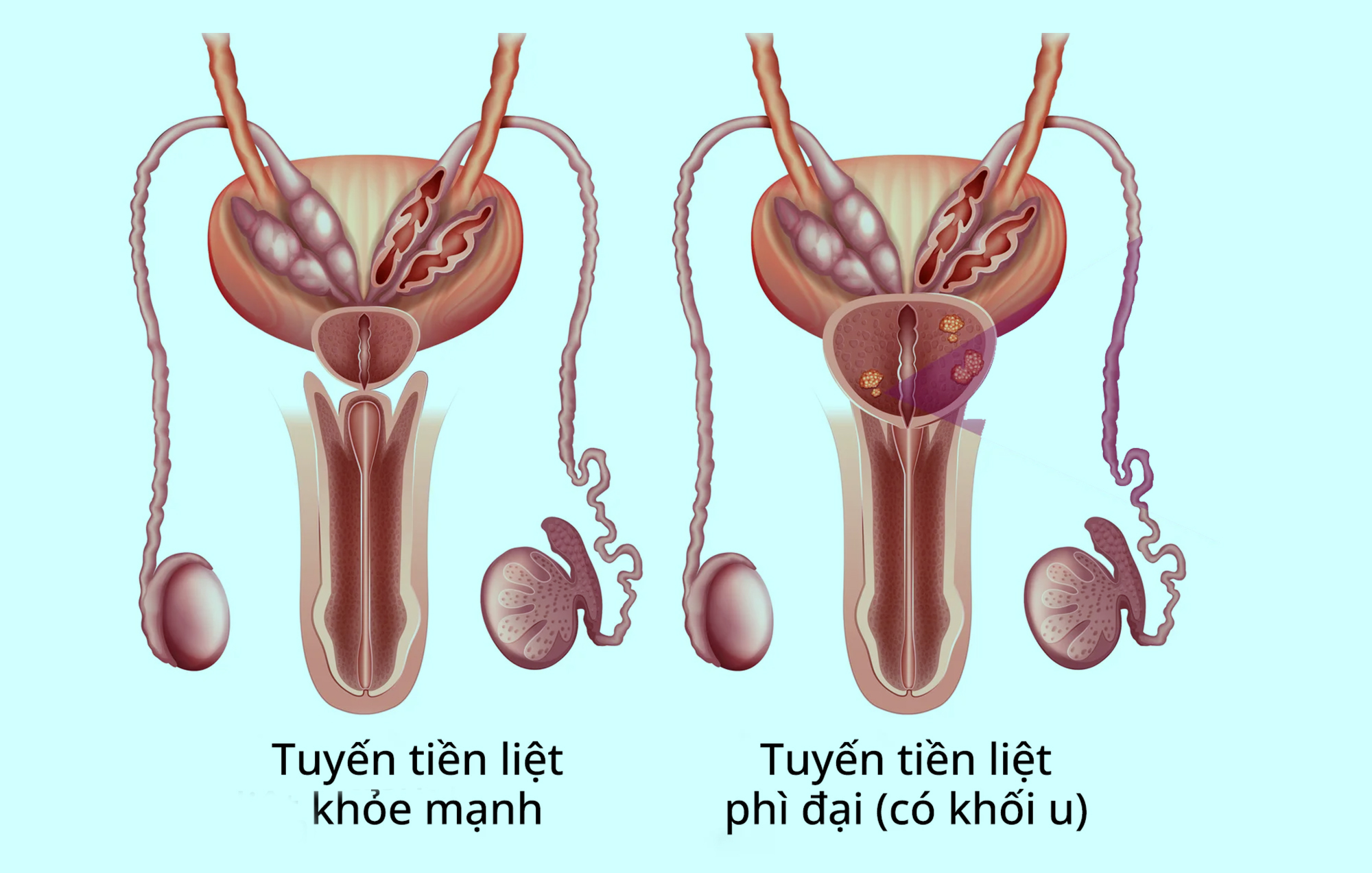 Phì đại tuyến tiền liệt có cần phẫu thuật?- Ảnh 1. Phì đại tuyến tiền liệt có cần phẫu thuật?- Ảnh 1.