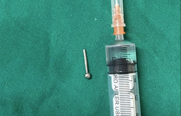 Nuốt phải khuyên lưỡi, thiếu nữ 19 tuổi nhập viện- Ảnh 1. Nuốt phải khuyên lưỡi, thiếu nữ 19 tuổi nhập viện- Ảnh 1.