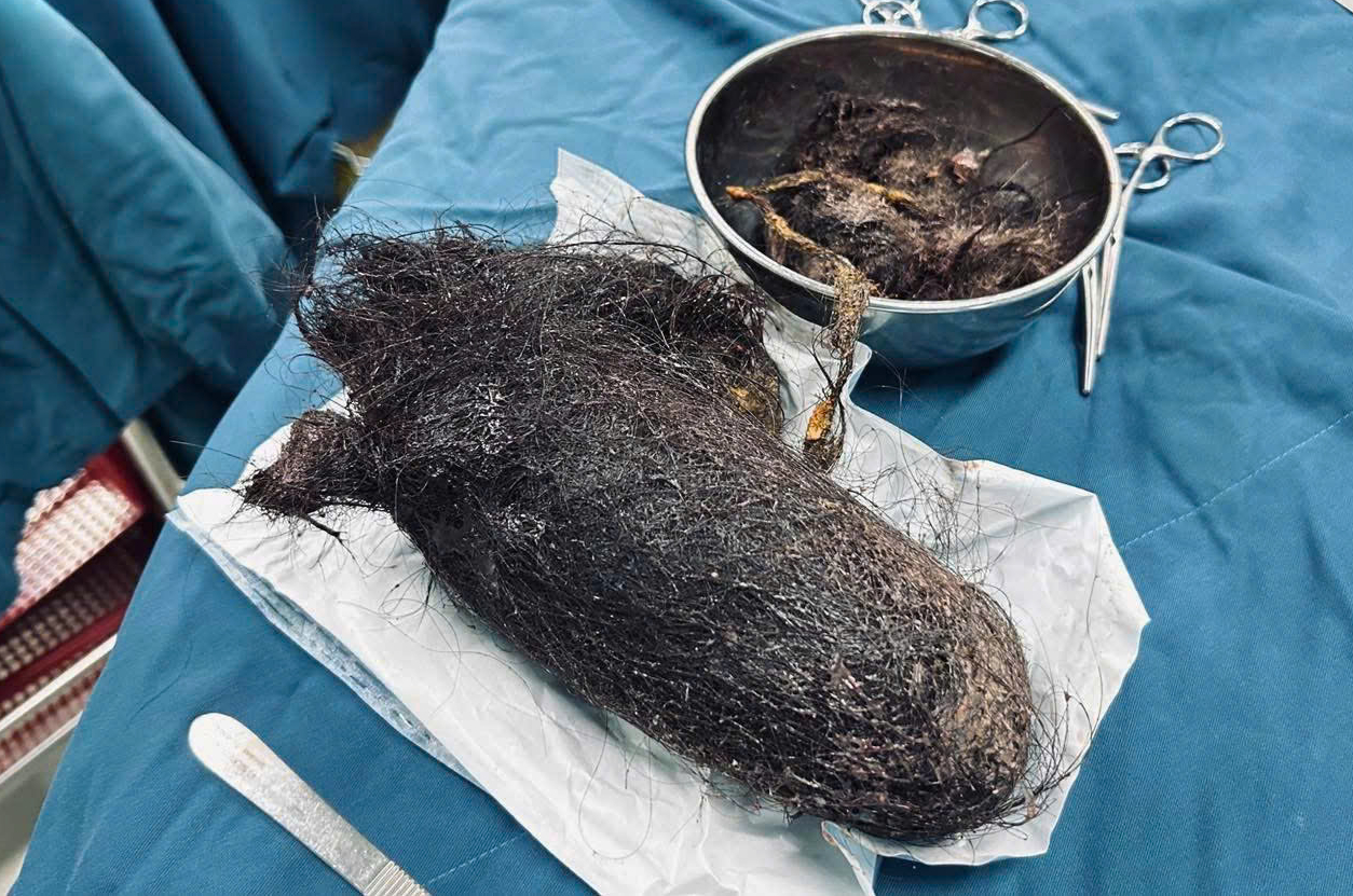 Búi tóc nặng gần 1kg nằm chắn ngang dạ dày bé gái 12 tuổi- Ảnh 1. Búi tóc nặng gần 1kg nằm chắn ngang dạ dày bé gái 12 tuổi- Ảnh 1.
